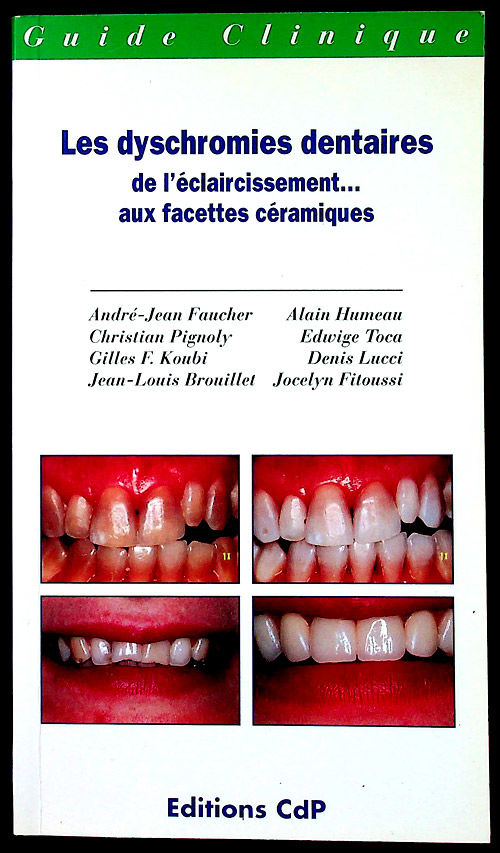 LES DYSCHROMIES DENTAIRES Eclaircissement-Blanchiment dents 35 Gravelines (59)